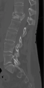 Lumbar vertebral fracture