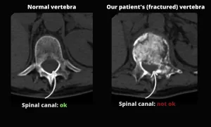 Normal vertebra vs. fractured vertebra