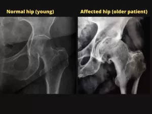 Normal vs. affected hip