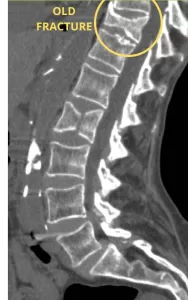 Old fracture of vertebra