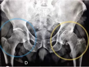 Osteoarthritis on left hip