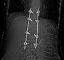 Vertebral fracture surgery