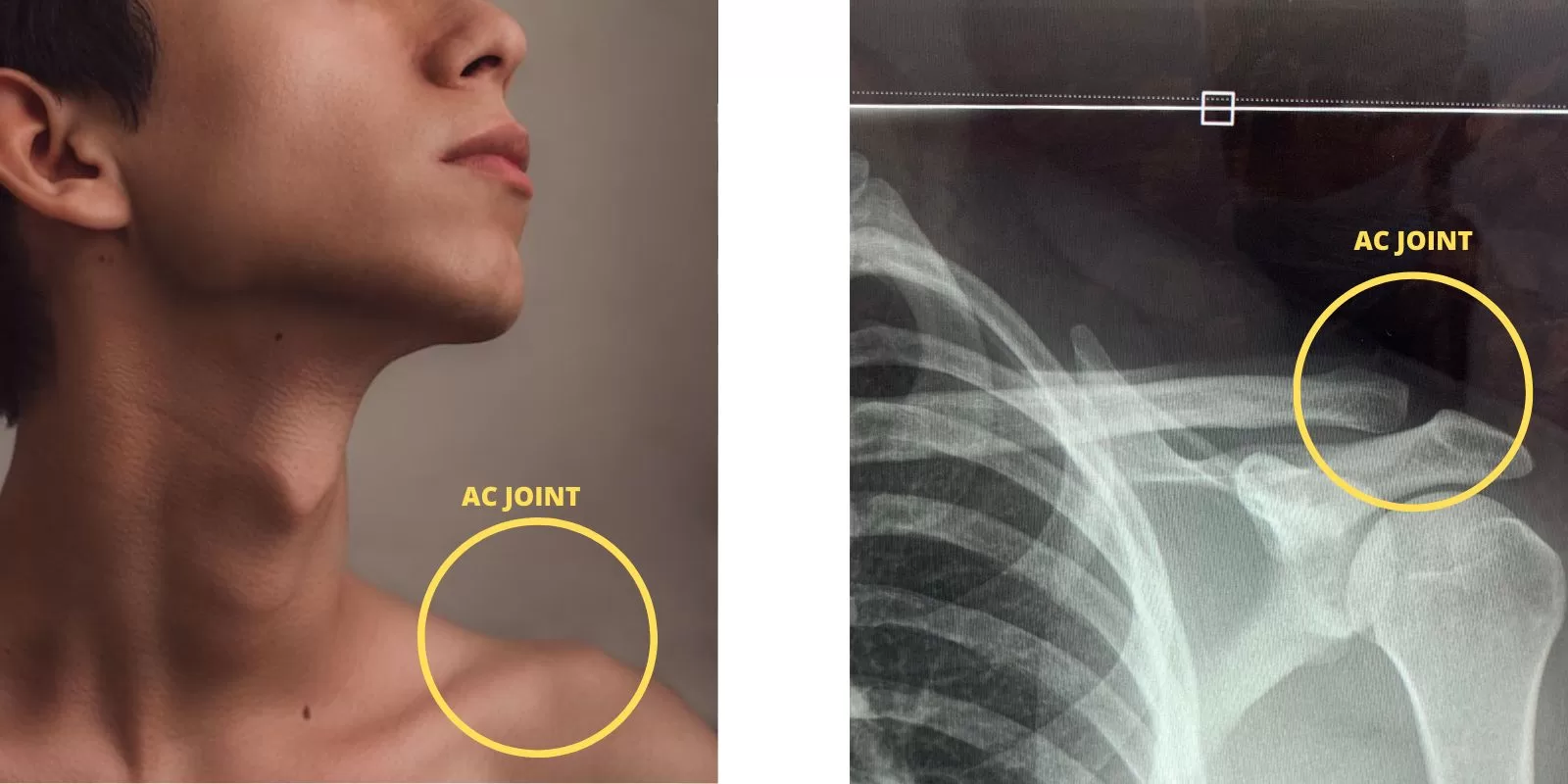 AC JOINT in a picture and x-ray