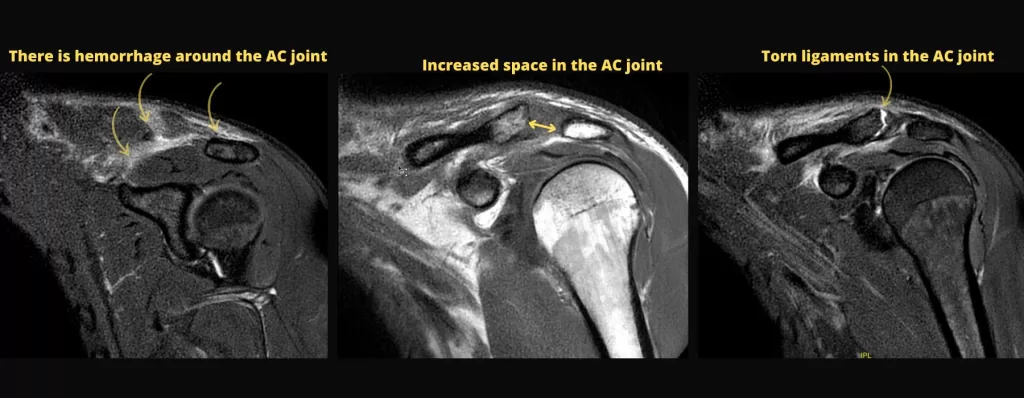 AC joint MRI showing torn ligaments, hemorrhage and increased articular space