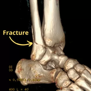 Fibula fracture after sprained ankle