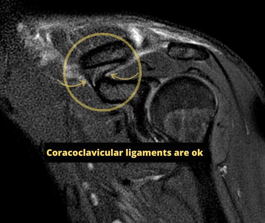 MRI of the shoulder showing the coracoclavicular ligaments are ok