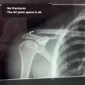 Mild AC joint injury on x-ray