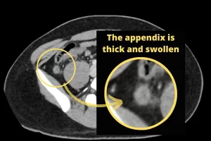 CT showing the appendix thick and swollen, consistent with appendicitis