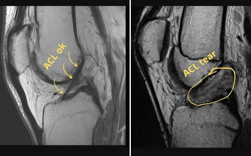 MRI of ACL vs ACL tear