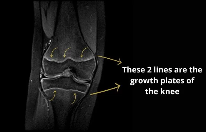MRI of the knee of a child showing both his growth plates