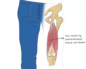 Hamstring muscle and tendon, which can be used for ACL reconstruction