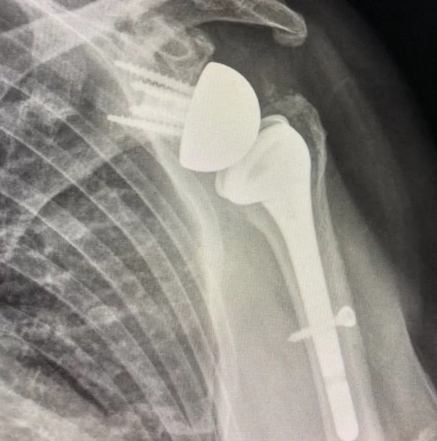 X-ray shoulder replacement