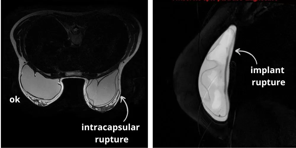 MRI showing breast implant intracapsular rupture