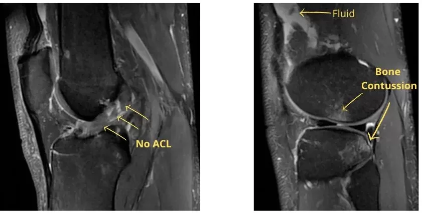 ACL rupture on MRI