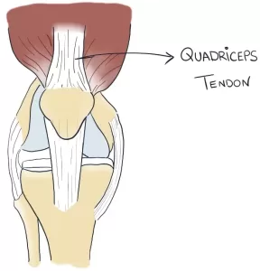 Quadriceps tendon for ACL reconstruction