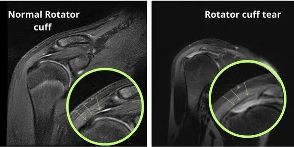 MRI showing normal rotator cuff vs tear