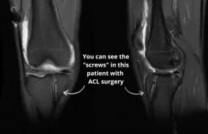 MRI showing some screws after ACL surgery
