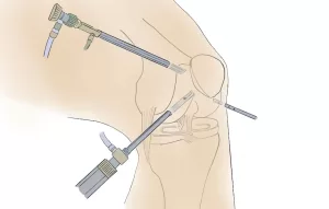 Knee arthroscopy to treat an ACL tear