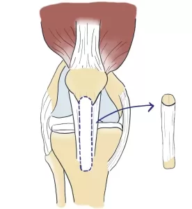 A graft obtained from the patella for ACL reconstruction