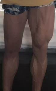 You can see what happens to a bodybuilder after several months of inactivity after a knee injury.