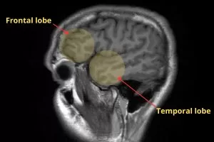 Brain MRI showing frontal and temporal lobes, affected in frontotemporal dementia