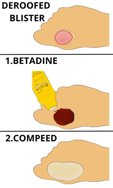 STEPS to treat a deroofed blister.