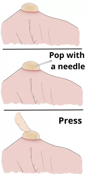 Blister being popped with a needle