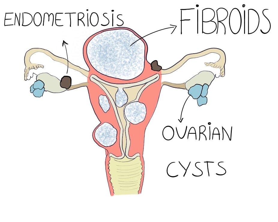 Endometriosis, fibroids and ovarian cysts drawing on a uterus as causes that make it harder to get pregnant after you turn 35