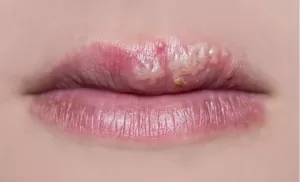 Mouth with cold sores on lips