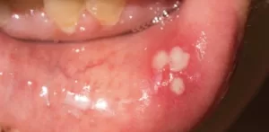 Canker sores