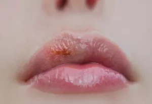 Cold sore on upper lip