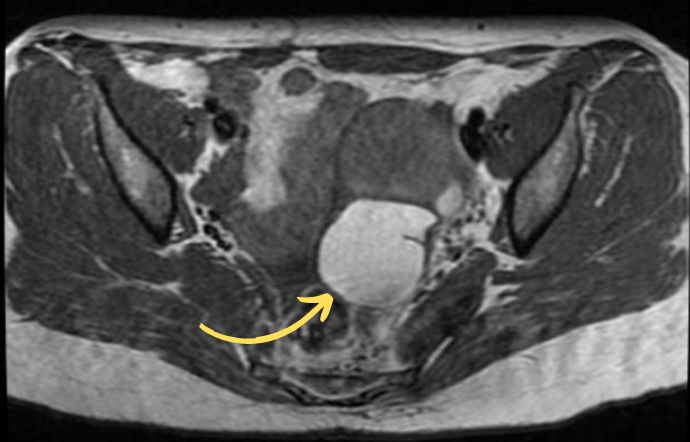 Pelvic MRI showing an endometriosis lesion on the left ovary