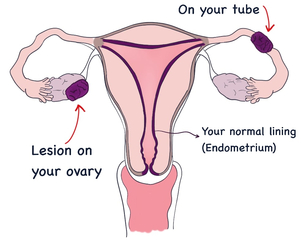 Drawing of a pelvis showing endometriosis lesions on the right ovary and on the left Fallopian tube