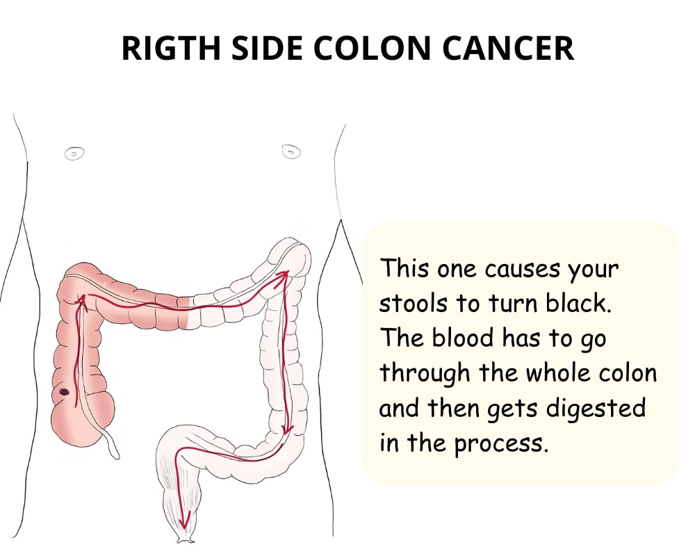 Blood in stools caused by right-colon cancer