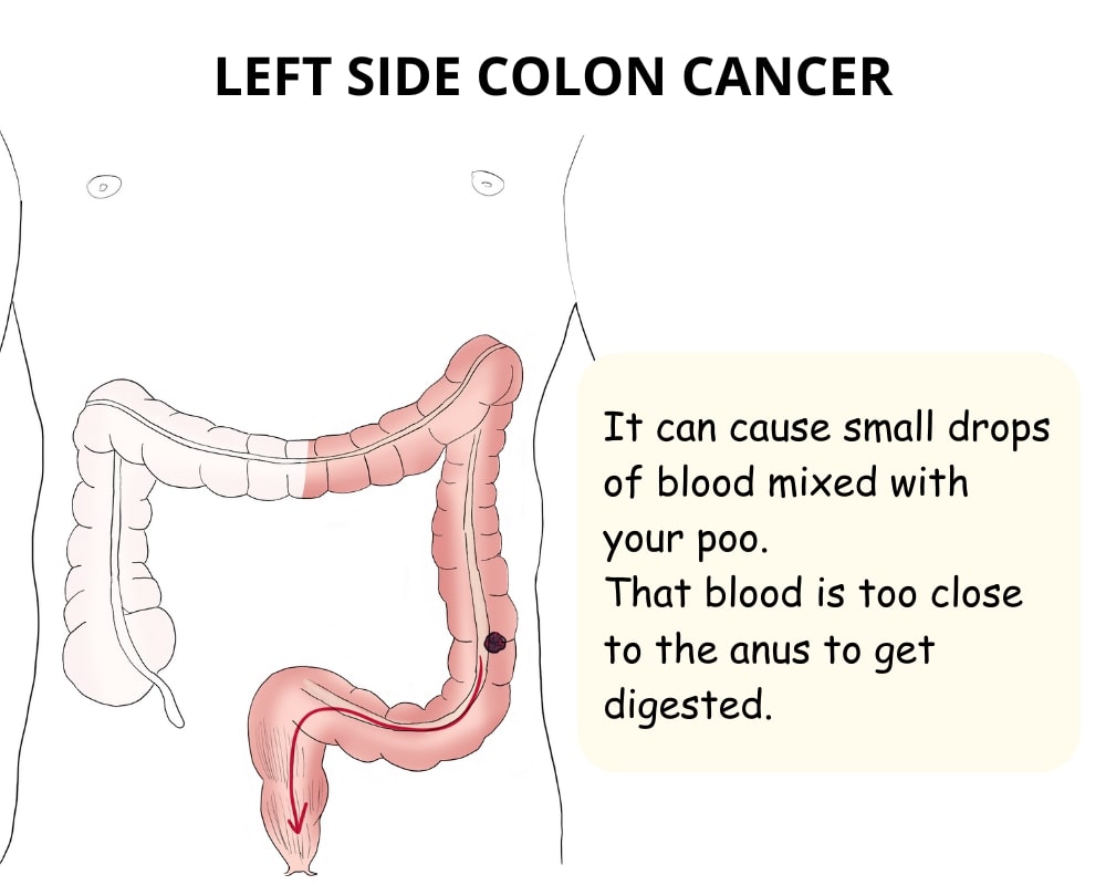 small droplets of blood in stools due to left side colon cancer