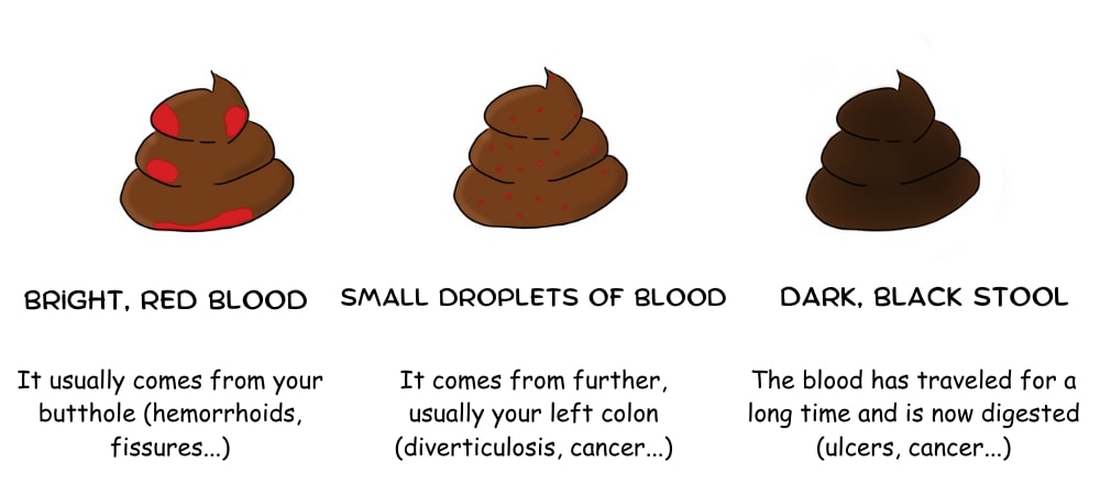 3 types of blood in your stool, depending where it came from in your digestive tract