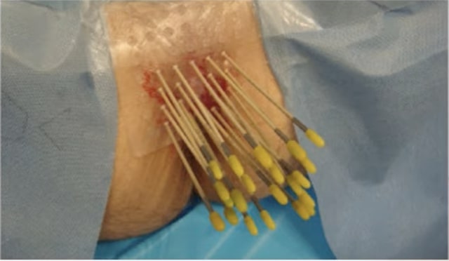 needles with the radiactive seeds for prostate brachytherapy