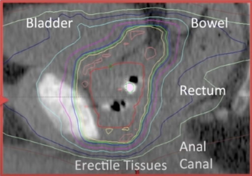 planning for radiation therapy