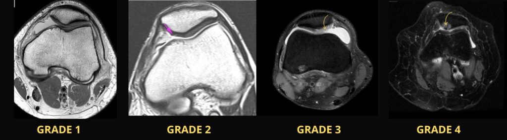 MRI showing grades of chondromalacia patellae