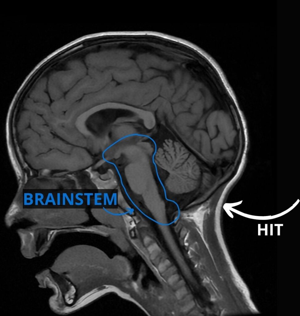 MRI of brain showing brainstem and hit to back of head